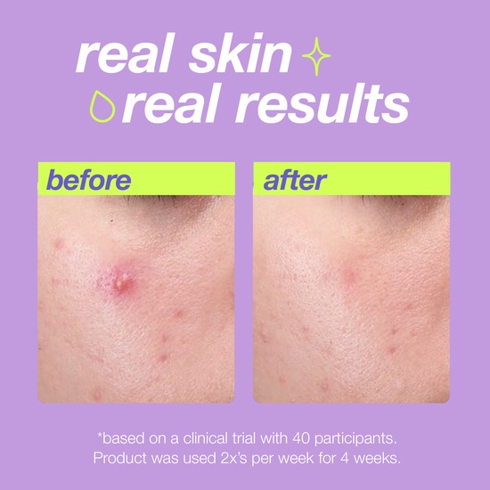 Dermalogica Breakout Clearing Liquid Peel 30 ml