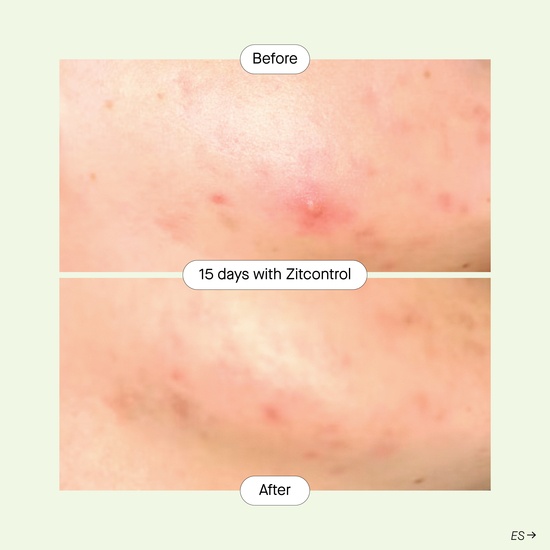 Niche Beauty Lab Zitcontrol 40 ml