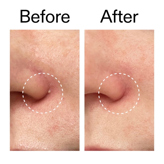 The INKEY List Hydrocolloid Invisible Pimple Patches 22 st