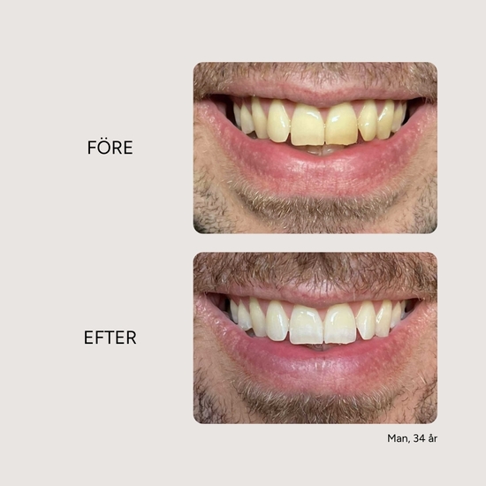 Etinour Essential Whitening & Remineralizing Kit