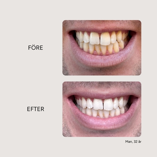 Etinour Essential Whitening & Remineralizing Kit