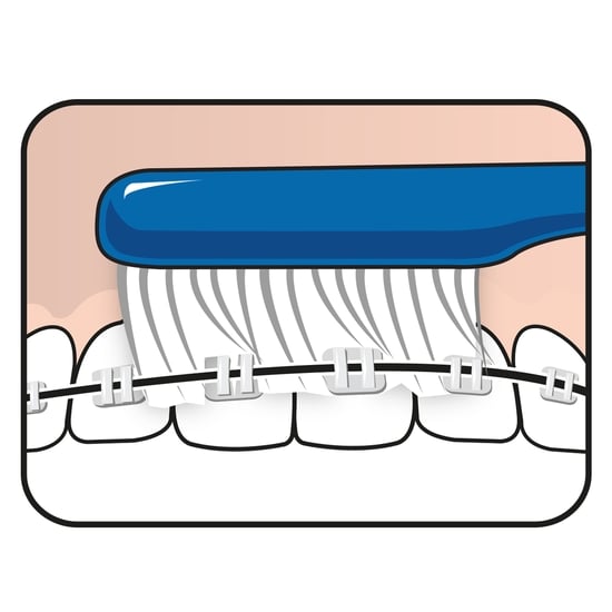 TePe Implant Orthodontic 1 st