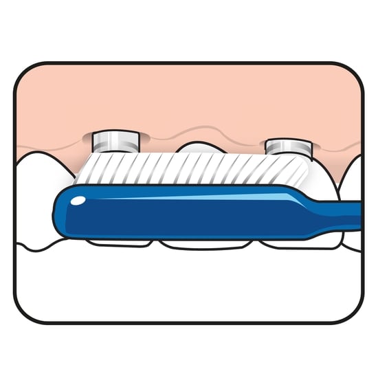 TePe Implant Orthodontic 1 st