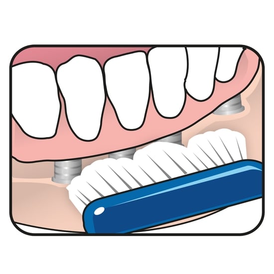 TePe Implant Orthodontic 1 st