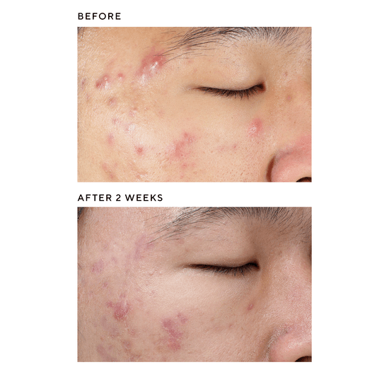 Murad Deep Relief Blemish Treatment 30 ml